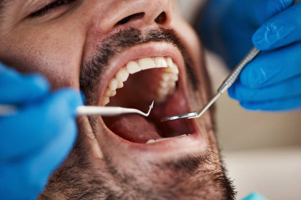 Best Emergency Dentist for Lost Fillings or Crowns in East Atlantic Beach, NY